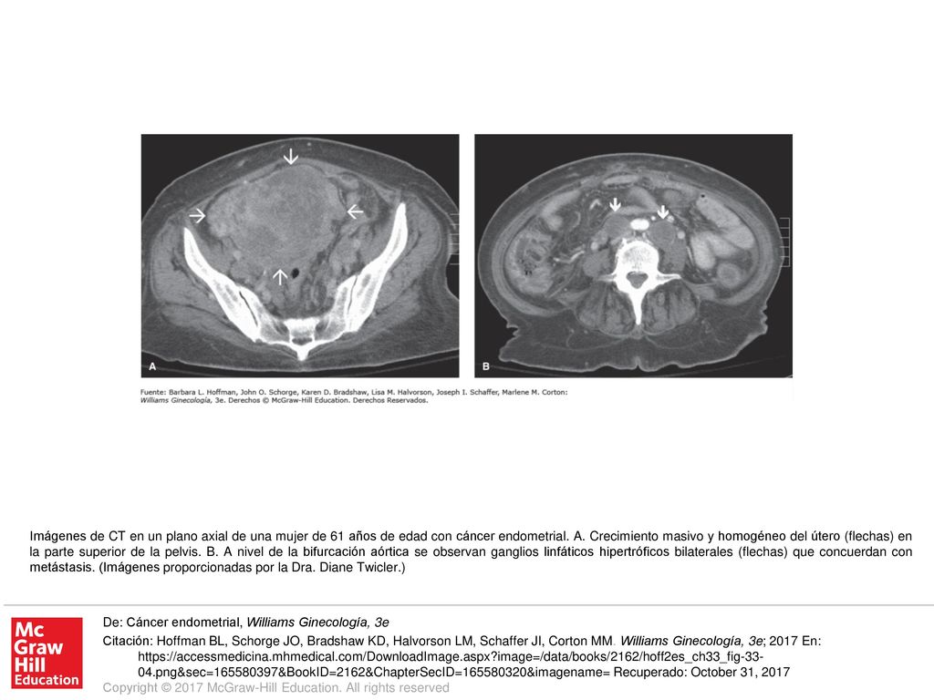 Imágenes de CT en un plano axial de una mujer de 61 años de edad con cáncer endometrial. A. Crecimiento masivo y homogéneo del útero (flechas) en la parte superior de la pelvis. B. A nivel de la bifurcación aórtica se observan ganglios linfáticos hipertróficos bilaterales (flechas) que concuerdan con metástasis. (Imágenes proporcionadas por la Dra. Diane Twicler.)