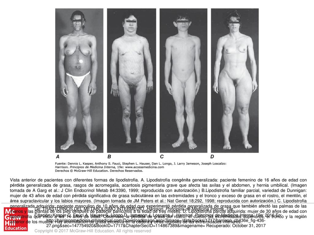 Vista anterior de pacientes con diferentes formas de lipodistrofia. A