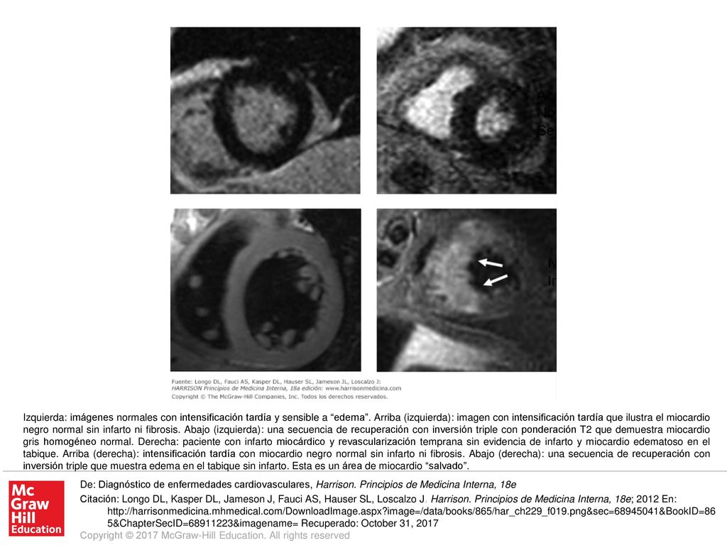 Izquierda: imágenes normales con intensificación tardía y sensible a edema . Arriba (izquierda): imagen con intensificación tardía que ilustra el miocardio negro normal sin infarto ni fibrosis. Abajo (izquierda): una secuencia de recuperación con inversión triple con ponderación T2 que demuestra miocardio gris homogéneo normal. Derecha: paciente con infarto miocárdico y revascularización temprana sin evidencia de infarto y miocardio edematoso en el tabique. Arriba (derecha): intensificación tardía con miocardio negro normal sin infarto ni fibrosis. Abajo (derecha): una secuencia de recuperación con inversión triple que muestra edema en el tabique sin infarto. Esta es un área de miocardio salvado .