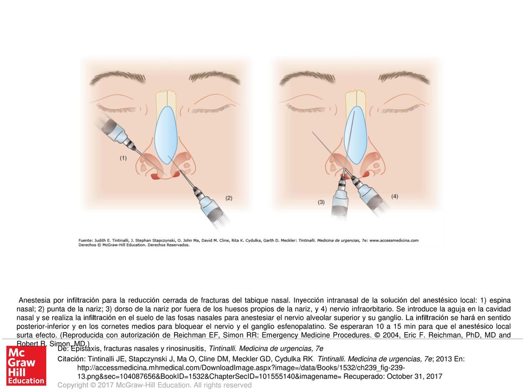 Anestesia por infiltración para la reducción cerrada de fracturas del tabique nasal. Inyección intranasal de la solución del anestésico local: 1) espina nasal; 2) punta de la nariz; 3) dorso de la nariz por fuera de los huesos propios de la nariz, y 4) nervio infraorbitario. Se introduce la aguja en la cavidad nasal y se realiza la infiltración en el suelo de las fosas nasales para anestesiar el nervio alveolar superior y su ganglio. La infiltración se hará en sentido posterior-inferior y en los cornetes medios para bloquear el nervio y el ganglio esfenopalatino. Se esperaran 10 a 15 min para que el anestésico local surta efecto. (Reproducida con autorización de Reichman EF, Simon RR: Emergency Medicine Procedures. © 2004, Eric F. Reichman, PhD, MD and Robert R. Simon, MD.)