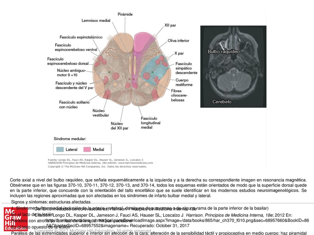 Parálisis o debilidad en las cuatro extremidades, además de toda la musculatura bulbar: haces corticobulbar y corticoespinal de forma bilateral