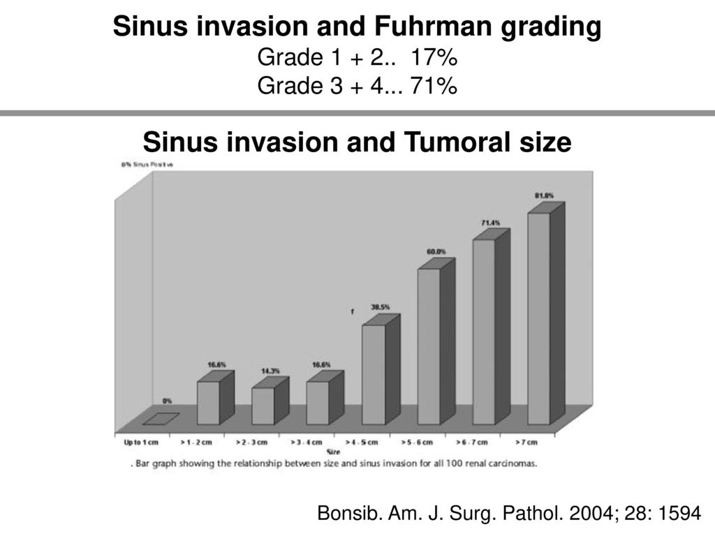 Sinus invasion and Fuhrman grading Sinus invasion and Tumoral size