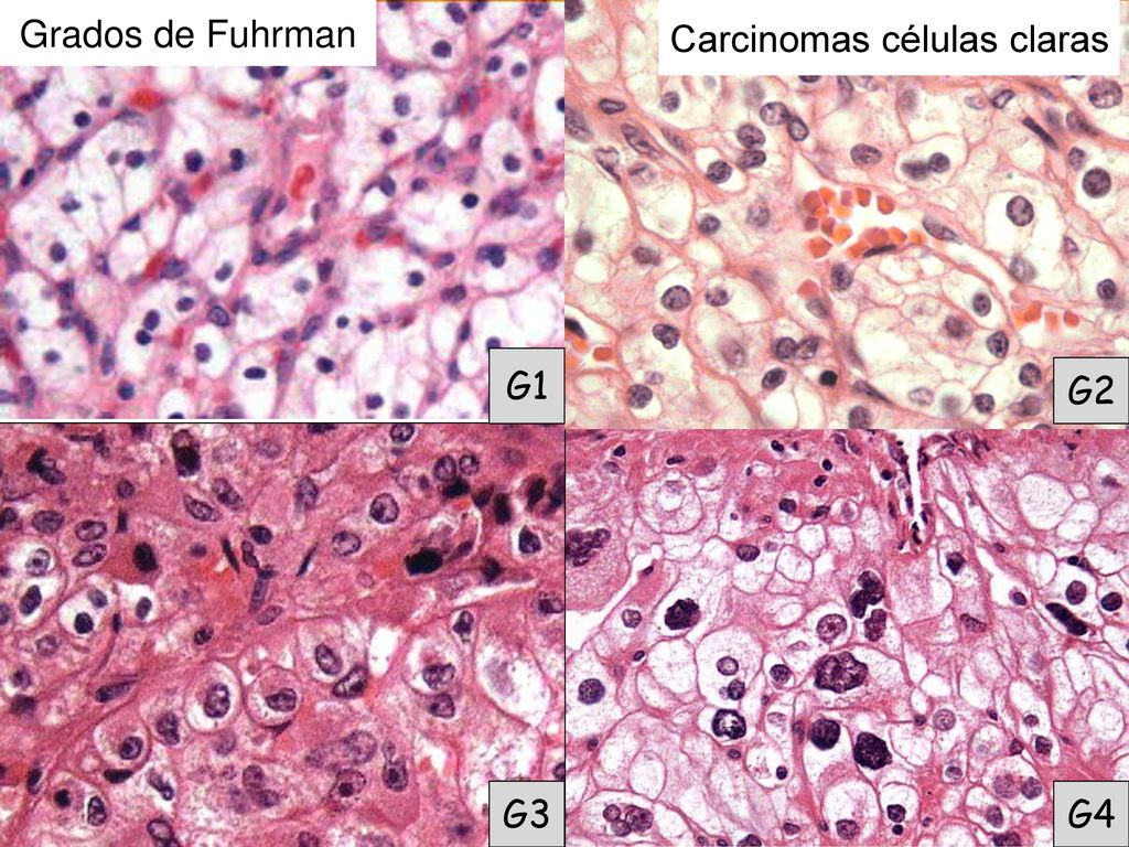Grados de Fuhrman Carcinomas células claras G1 G2 G3 G4