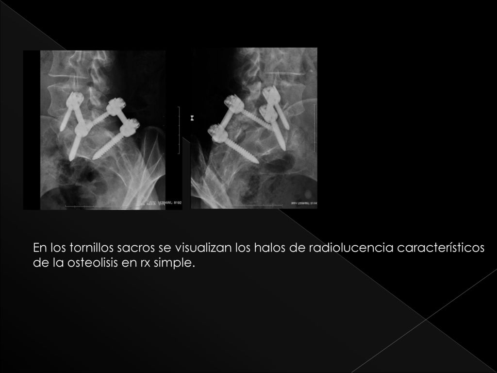 La En los tornillos sacros se visualizan los halos de radiolucencia característicos.