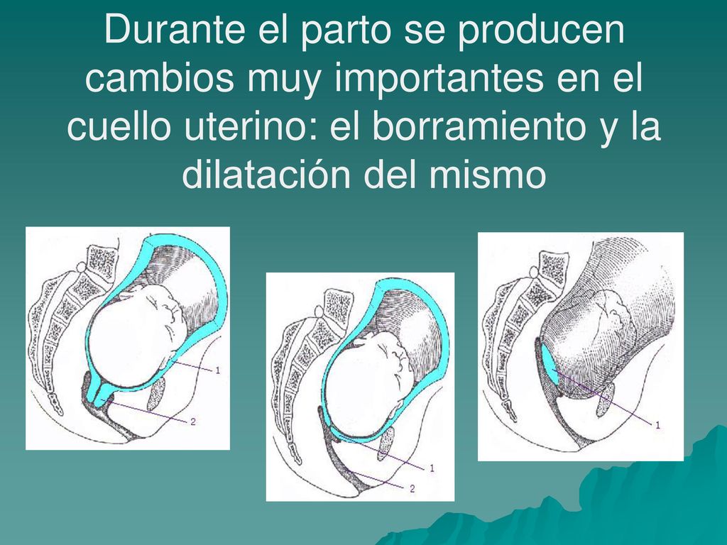 Durante el parto se producen cambios muy importantes en el cuello uterino: el borramiento y la dilatación del mismo