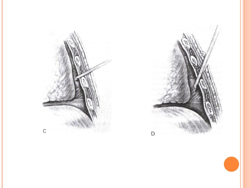 Técnica del catéter en la toracocentesis de un derrame pleural libre