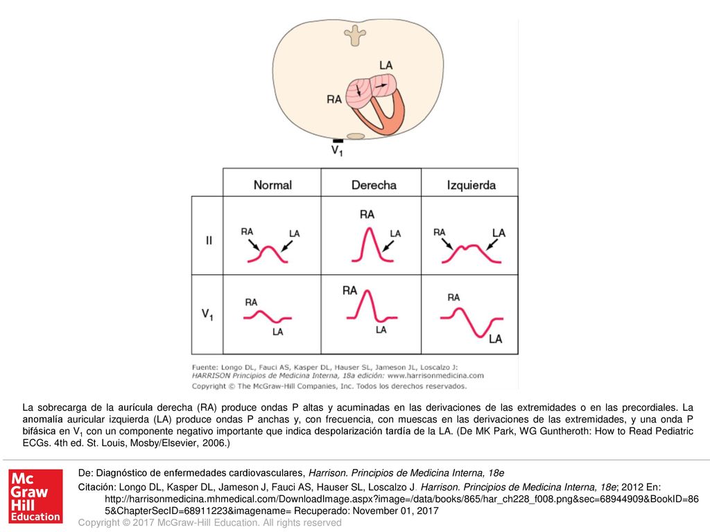 La sobrecarga de la aurícula derecha (RA) produce ondas P altas y acuminadas en las derivaciones de las extremidades o en las precordiales. La anomalía auricular izquierda (LA) produce ondas P anchas y, con frecuencia, con muescas en las derivaciones de las extremidades, y una onda P bifásica en V1 con un componente negativo importante que indica despolarización tardía de la LA. (De MK Park, WG Guntheroth: How to Read Pediatric ECGs. 4th ed. St. Louis, Mosby/Elsevier, 2006.)