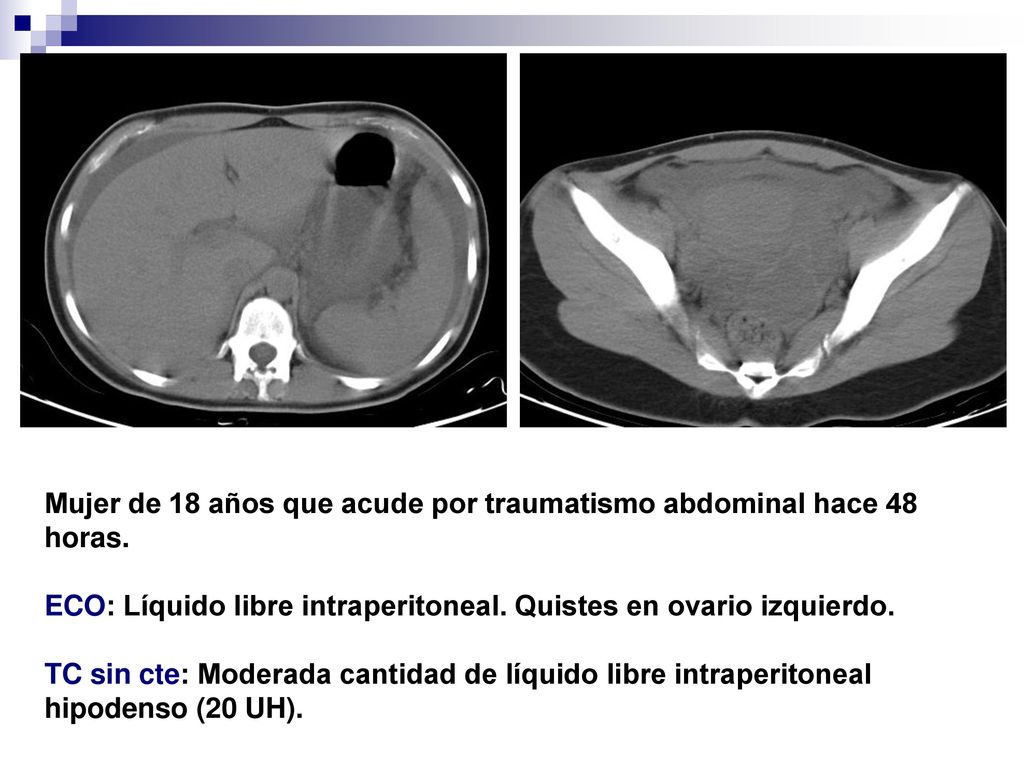 Mujer de 18 años que acude por traumatismo abdominal hace 48 horas.