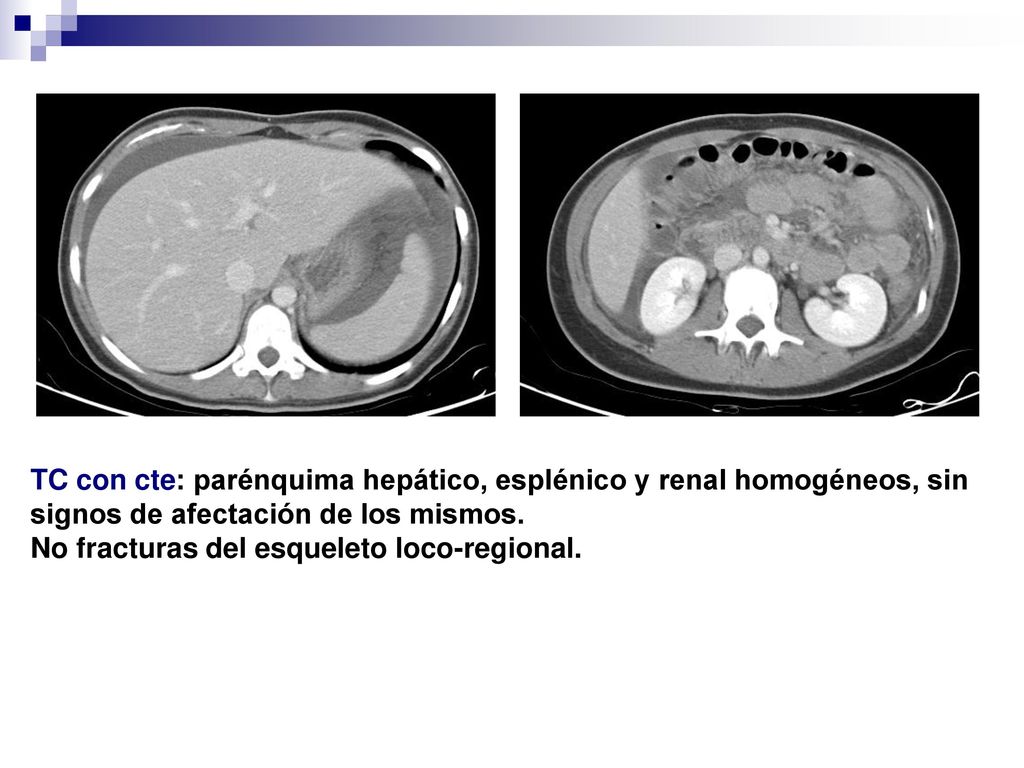 TC con cte: parénquima hepático, esplénico y renal homogéneos, sin signos de afectación de los mismos.