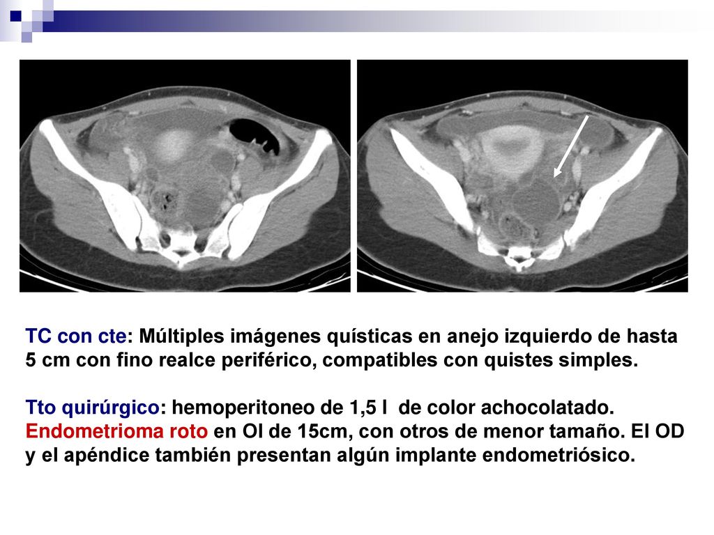 TC con cte: Múltiples imágenes quísticas en anejo izquierdo de hasta 5 cm con fino realce periférico, compatibles con quistes simples.