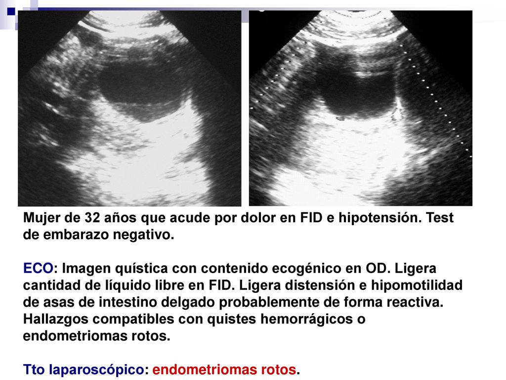 Mujer de 32 años que acude por dolor en FID e hipotensión
