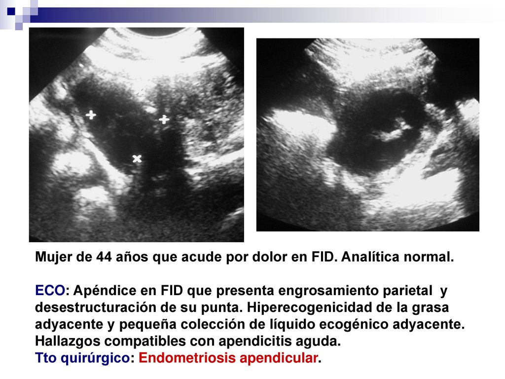 Mujer de 44 años que acude por dolor en FID. Analítica normal.