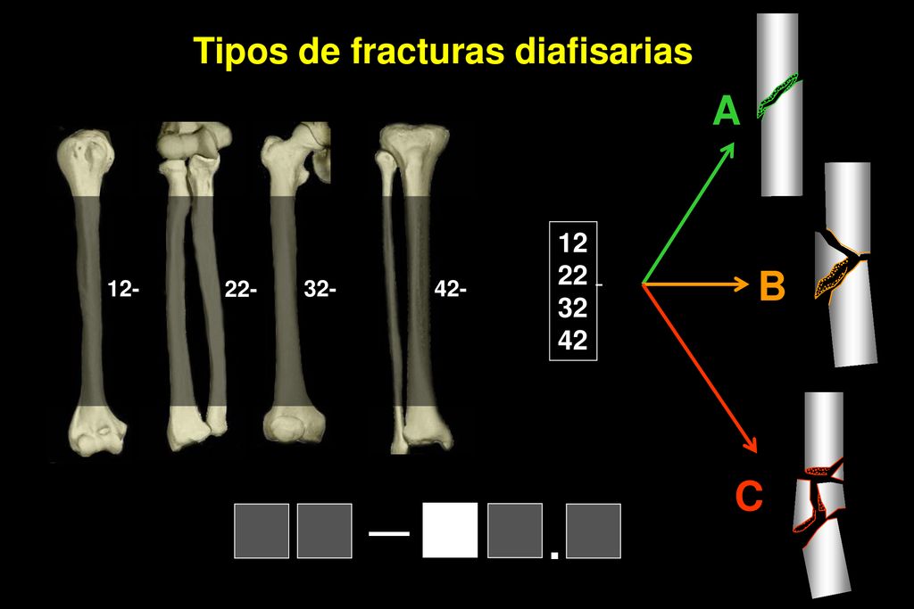A B C — . Tipos de fracturas diafisarias