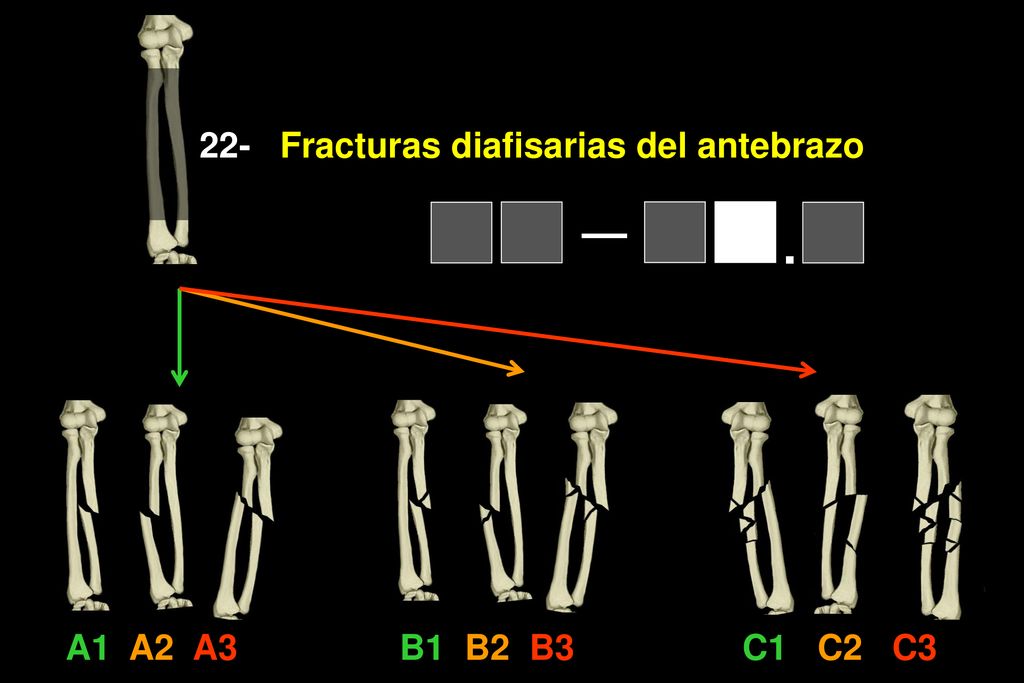22- A1 A2 A3 B1 B2 B3 C1 C2 C3 Fracturas diafisarias del antebrazo — .