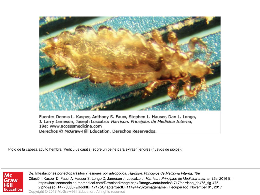Piojo de la cabeza adulto hembra (Pediculus capitis) sobre un peine para extraer liendres (huevos de piojos).