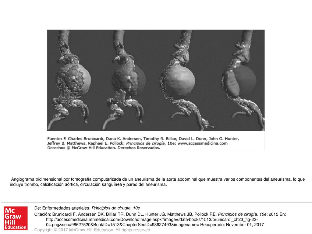 Angiograma tridimensional por tomografía computarizada de un aneurisma de la aorta abdominal que muestra varios componentes del aneurisma, lo que incluye trombo, calcificación aórtica, circulación sanguínea y pared del aneurisma.