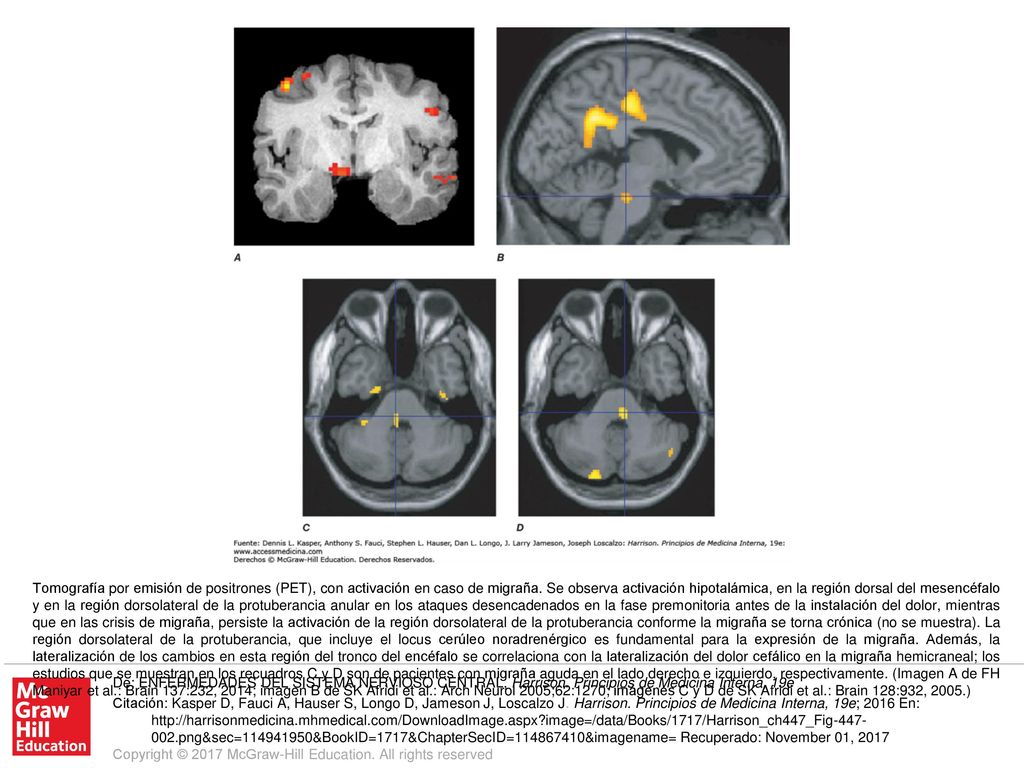 Tomografía por emisión de positrones (PET), con activación en caso de migraña. Se observa activación hipotalámica, en la región dorsal del mesencéfalo y en la región dorsolateral de la protuberancia anular en los ataques desencadenados en la fase premonitoria antes de la instalación del dolor, mientras que en las crisis de migraña, persiste la activación de la región dorsolateral de la protuberancia conforme la migraña se torna crónica (no se muestra). La región dorsolateral de la protuberancia, que incluye el locus cerúleo noradrenérgico es fundamental para la expresión de la migraña. Además, la lateralización de los cambios en esta región del tronco del encéfalo se correlaciona con la lateralización del dolor cefálico en la migraña hemicraneal; los estudios que se muestran en los recuadros C y D son de pacientes con migraña aguda en el lado derecho e izquierdo, respectivamente. (Imagen A de FH Maniyar et al.: Brain 137:232, 2014; imagen B de SK Afridi et al.: Arch Neurol 2005;62:1270; imágenes C y D de SK Afridi et al.: Brain 128:932, 2005.)