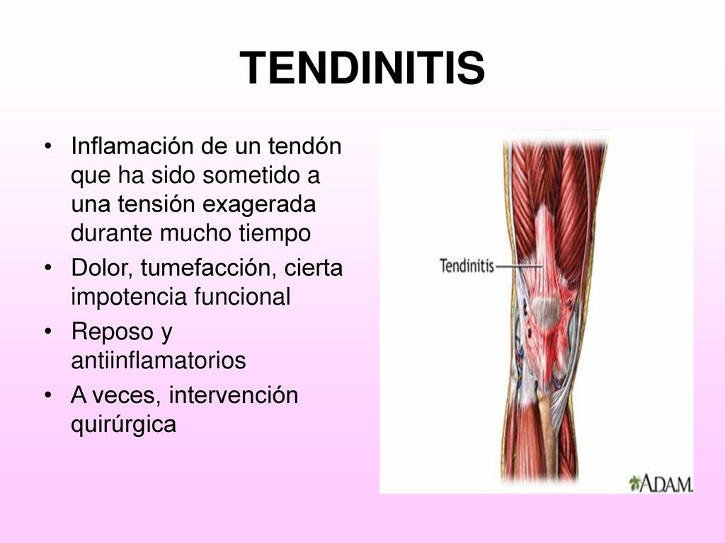 TENDINITIS Inflamación de un tendón que ha sido sometido a una tensión exagerada durante mucho tiempo.