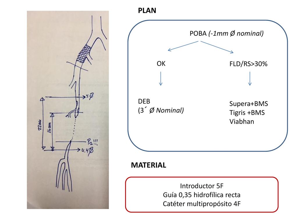 PLAN MATERIAL POBA (-1mm Ø nominal) OK FLD/RS>30% DEB Supera+BMS