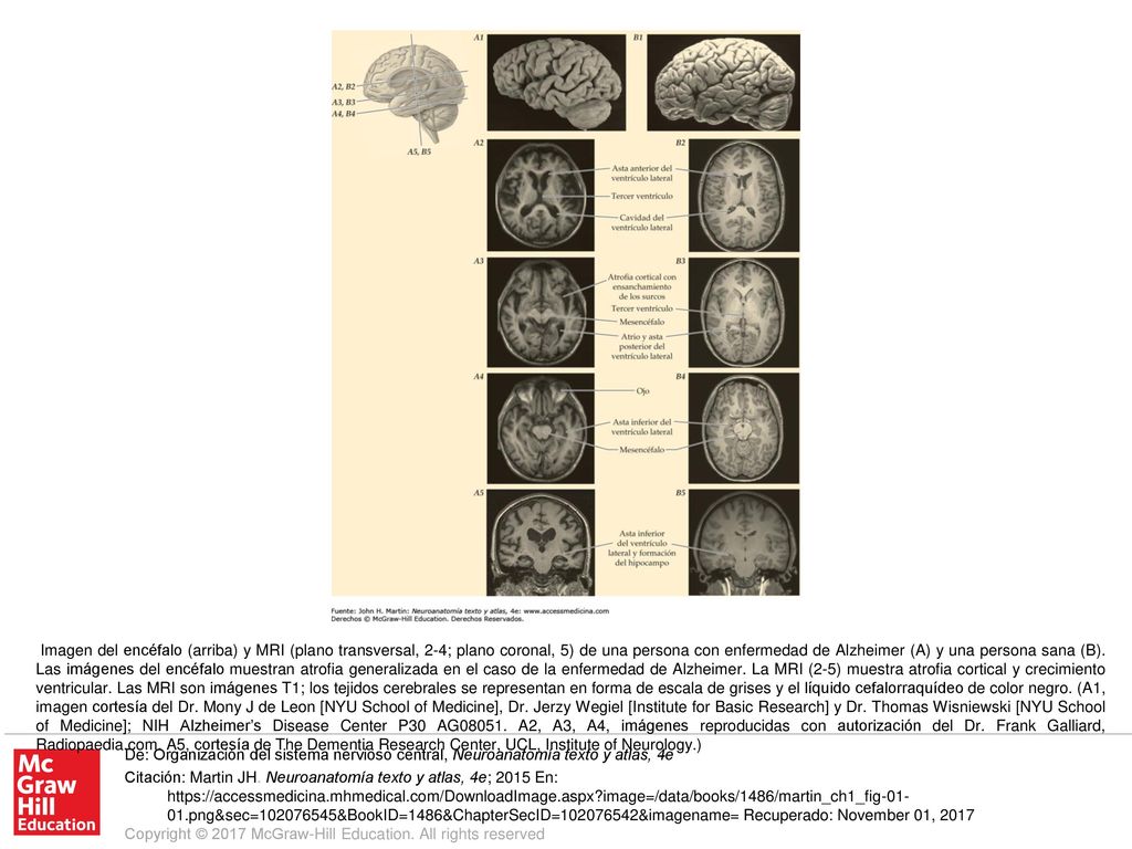 Imagen del encéfalo (arriba) y MRI (plano transversal, 2-4; plano coronal, 5) de una persona con enfermedad de Alzheimer (A) y una persona sana (B). Las imágenes del encéfalo muestran atrofia generalizada en el caso de la enfermedad de Alzheimer. La MRI (2-5) muestra atrofia cortical y crecimiento ventricular. Las MRI son imágenes T1; los tejidos cerebrales se representan en forma de escala de grises y el líquido cefalorraquídeo de color negro. (A1, imagen cortesía del Dr. Mony J de Leon [NYU School of Medicine], Dr. Jerzy Wegiel [Institute for Basic Research] y Dr. Thomas Wisniewski [NYU School of Medicine]; NIH Alzheimer’s Disease Center P30 AG A2, A3, A4, imágenes reproducidas con autorización del Dr. Frank Galliard, Radiopaedia.com. A5, cortesía de The Dementia Research Center, UCL, Institute of Neurology.)