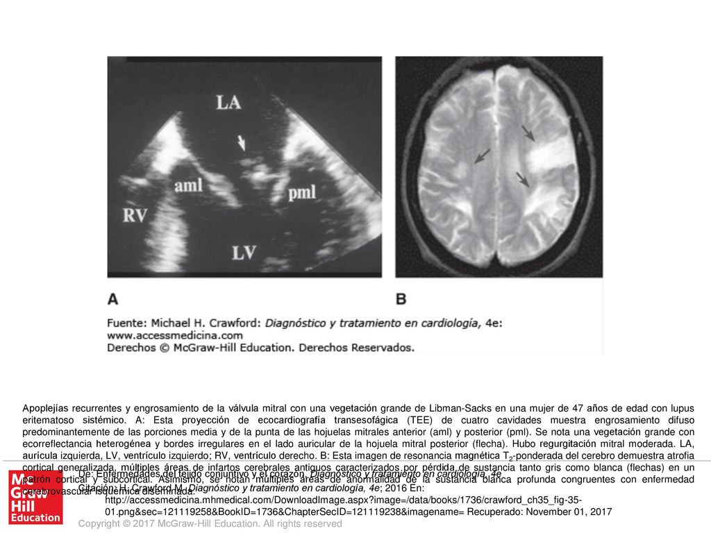Apoplejías recurrentes y engrosamiento de la válvula mitral con una vegetación grande de Libman-Sacks en una mujer de 47 años de edad con lupus eritematoso sistémico. A: Esta proyección de ecocardiografía transesofágica (TEE) de cuatro cavidades muestra engrosamiento difuso predominantemente de las porciones media y de la punta de las hojuelas mitrales anterior (aml) y posterior (pml). Se nota una vegetación grande con ecorreflectancia heterogénea y bordes irregulares en el lado auricular de la hojuela mitral posterior (flecha). Hubo regurgitación mitral moderada. LA, aurícula izquierda, LV, ventrículo izquierdo; RV, ventrículo derecho. B: Esta imagen de resonancia magnética T2-ponderada del cerebro demuestra atrofia cortical generalizada, múltiples áreas de infartos cerebrales antiguos caracterizados por pérdida de sustancia tanto gris como blanca (flechas) en un patrón cortical y subcortical. Asimismo, se notan múltiples áreas de anormalidad de la sustancia blanca profunda congruentes con enfermedad cerebrovascular isquémica diseminada.