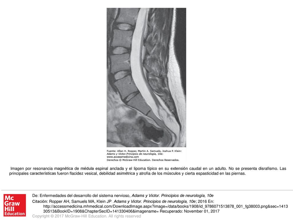 Imagen por resonancia magnética de médula espinal anclada y el lipoma típico en su extensión caudal en un adulto. No se presenta disrafismo. Las principales características fueron flacidez vesical, debilidad asimétrica y atrofia de los músculos y cierta espasticidad en las piernas.