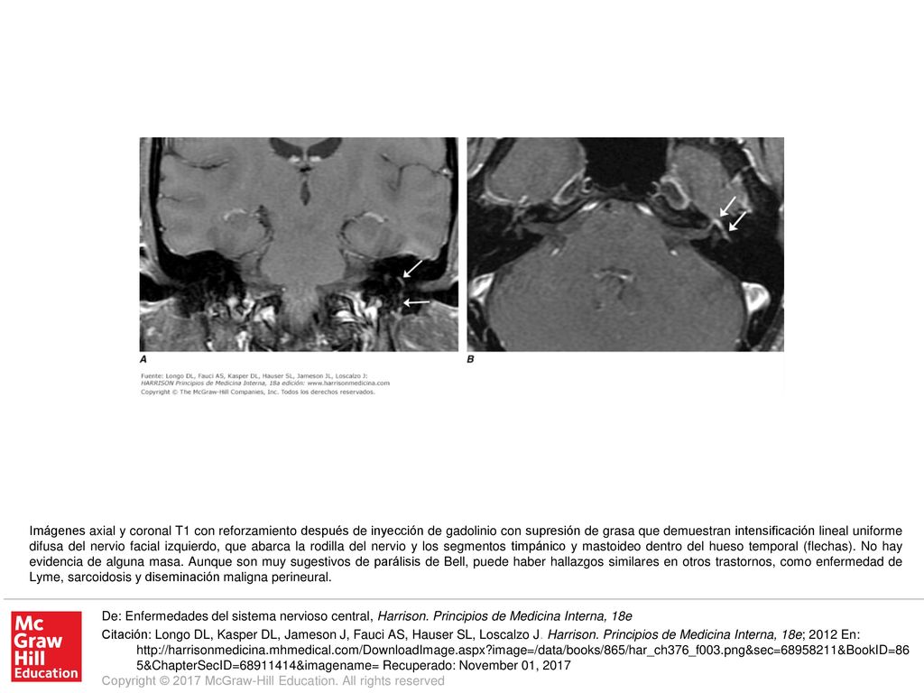Imágenes axial y coronal T1 con reforzamiento después de inyección de gadolinio con supresión de grasa que demuestran intensificación lineal uniforme difusa del nervio facial izquierdo, que abarca la rodilla del nervio y los segmentos timpánico y mastoideo dentro del hueso temporal (flechas). No hay evidencia de alguna masa. Aunque son muy sugestivos de parálisis de Bell, puede haber hallazgos similares en otros trastornos, como enfermedad de Lyme, sarcoidosis y diseminación maligna perineural.