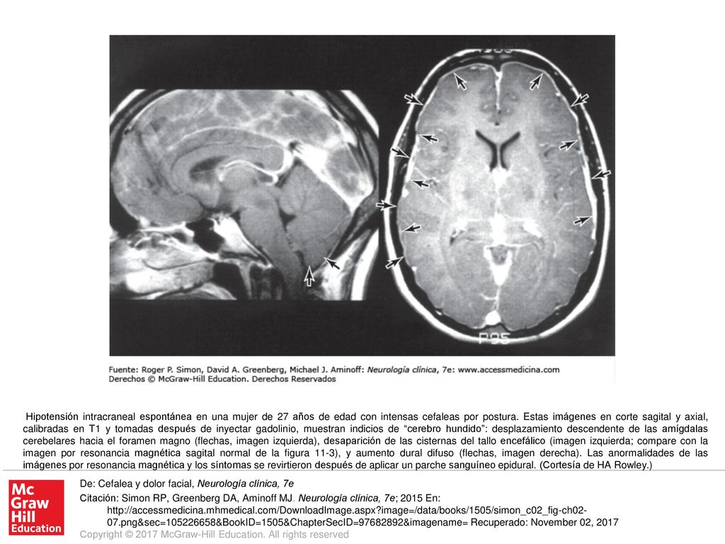 Hipotensión intracraneal espontánea en una mujer de 27 años de edad con intensas cefaleas por postura. Estas imágenes en corte sagital y axial, calibradas en T1 y tomadas después de inyectar gadolinio, muestran indicios de cerebro hundido : desplazamiento descendente de las amígdalas cerebelares hacia el foramen magno (flechas, imagen izquierda), desaparición de las cisternas del tallo encefálico (imagen izquierda; compare con la imagen por resonancia magnética sagital normal de la figura 11-3), y aumento dural difuso (flechas, imagen derecha). Las anormalidades de las imágenes por resonancia magnética y los síntomas se revirtieron después de aplicar un parche sanguíneo epidural. (Cortesía de HA Rowley.)