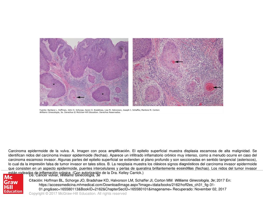 Carcinoma epidermoide de la vulva. A. Imagen con poca amplificación