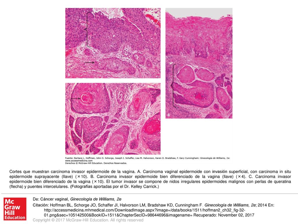 Cortes que muestran carcinoma invasor epidermoide de la vagina. A