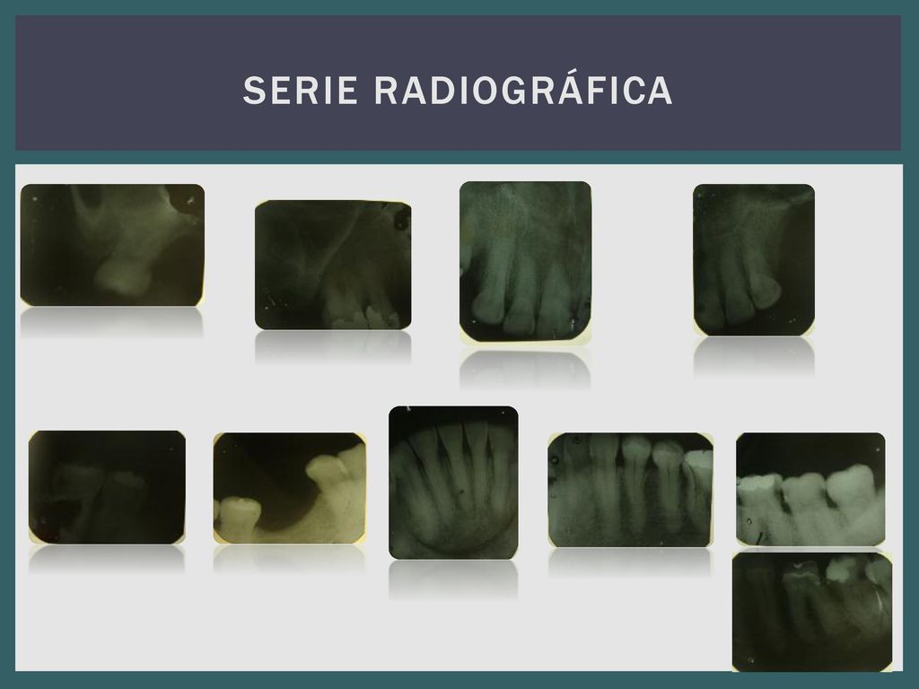 Serie Radiográfica Radiográficamente se observa caries interproximal en piezas 36 y 37, resorción ósea a nivel de cresta por lo que se.