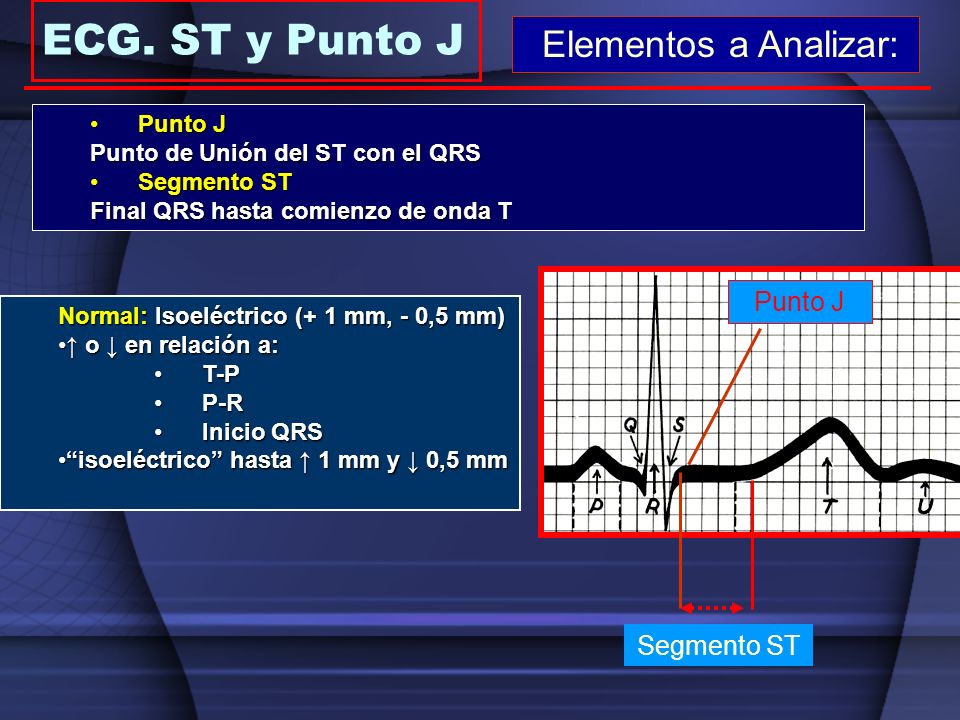 ECG. ST y Punto J Elementos a Analizar: Punto J Segmento ST Punto J