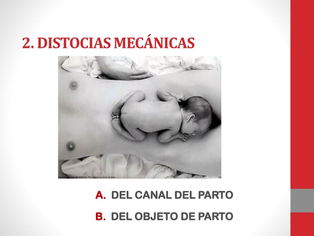 2. Distocias mecánicas DEL CANAL DEL PARTO DEL OBJETO DE PARTO