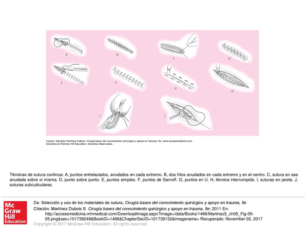 Técnicas de sutura continua: A, puntos entrelazados, anudados en cada extremo. B, dos hilos anudados en cada extremo y en el centro. C, sutura en asa anudada sobre sí misma. D, punto sobre punto. E, puntos simples. F, puntos de Sarnoff. G, puntos en U. H, técnica interrumpida. I, suturas en jareta. J, suturas subcuticulares.