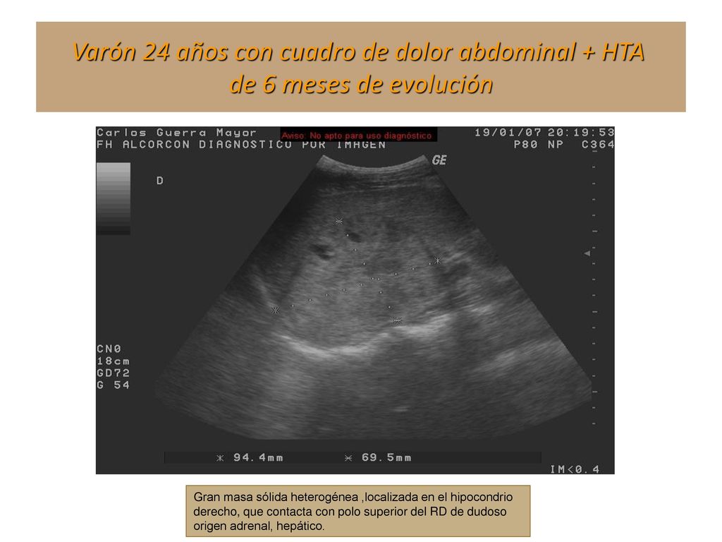 Varón 24 años con cuadro de dolor abdominal + HTA de 6 meses de evolución