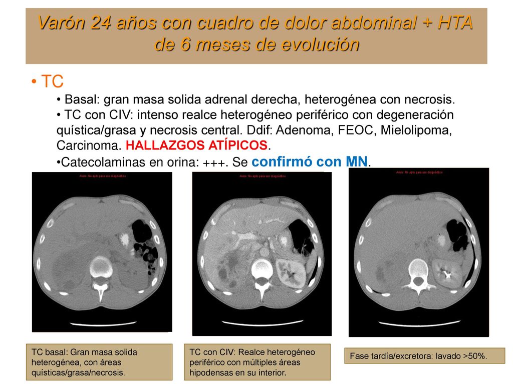 Varón 24 años con cuadro de dolor abdominal + HTA de 6 meses de evolución