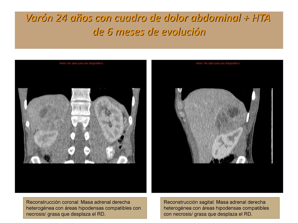 Varón 24 años con cuadro de dolor abdominal + HTA de 6 meses de evolución