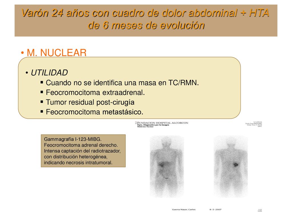 Varón 24 años con cuadro de dolor abdominal + HTA de 6 meses de evolución