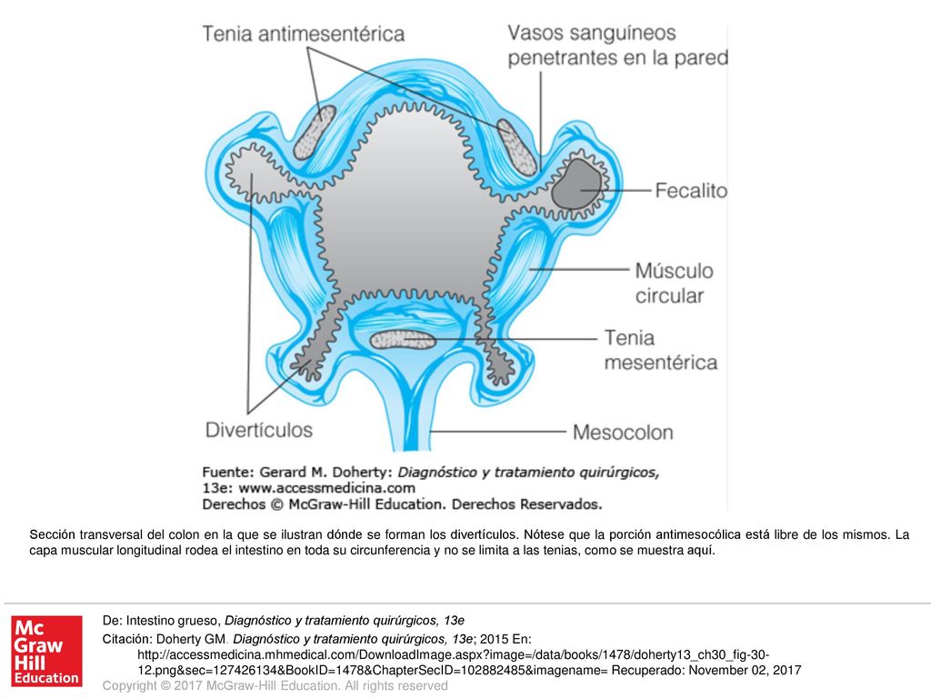 Sección transversal del colon en la que se ilustran dónde se forman los divertículos. Nótese que la porción antimesocólica está libre de los mismos. La capa muscular longitudinal rodea el intestino en toda su circunferencia y no se limita a las tenias, como se muestra aquí.