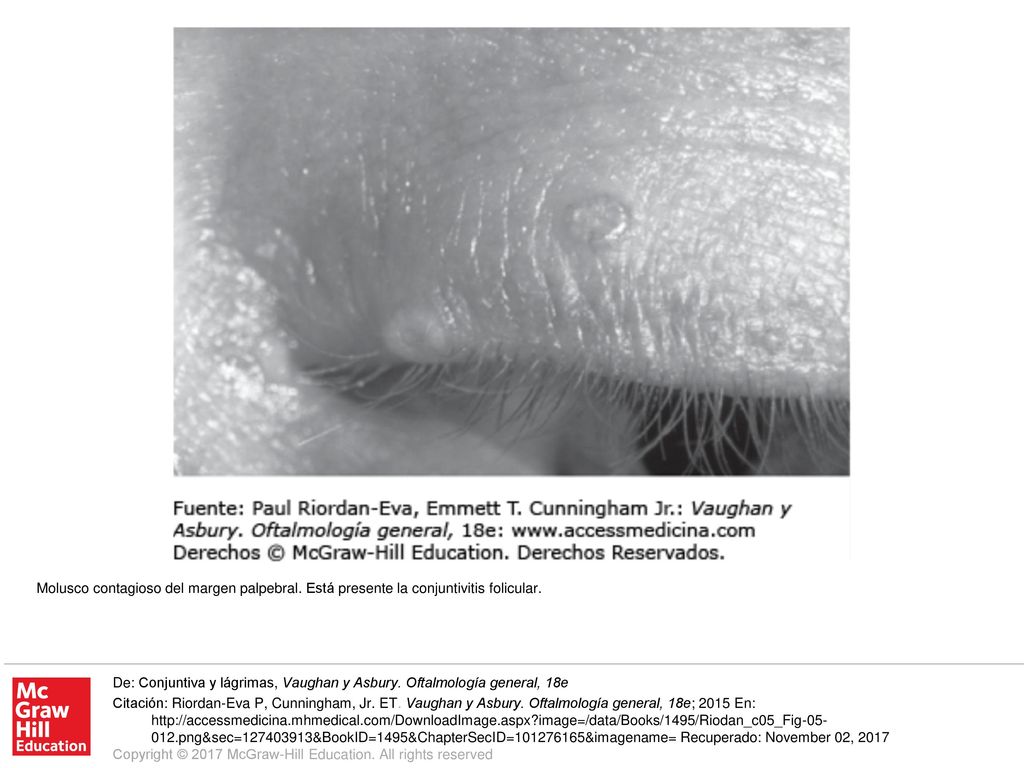Molusco contagioso del margen palpebral