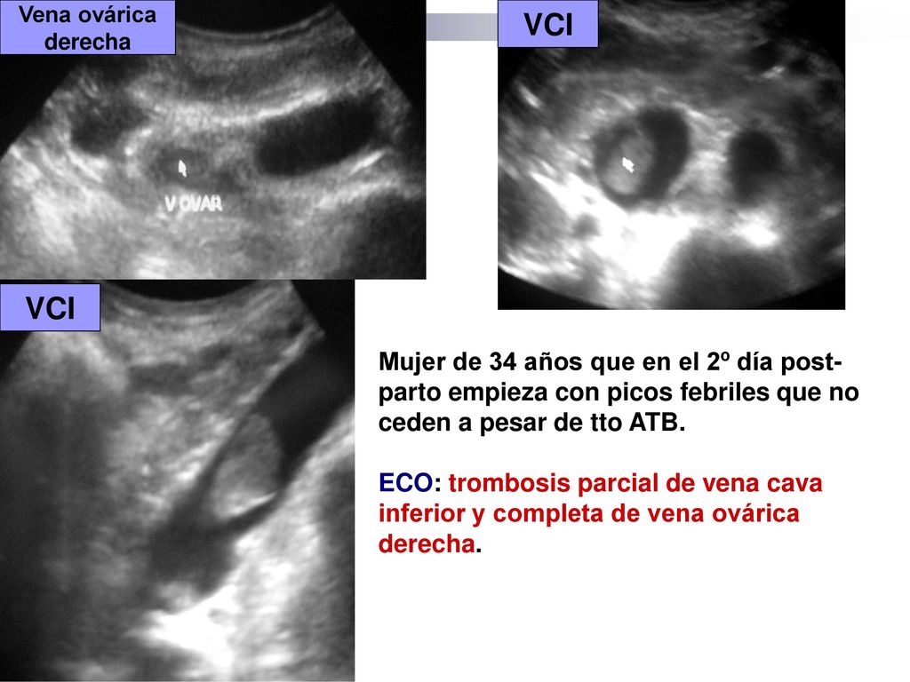 Vena ovárica derecha. VCI. VCI. Mujer de 34 años que en el 2º día post-parto empieza con picos febriles que no ceden a pesar de tto ATB.