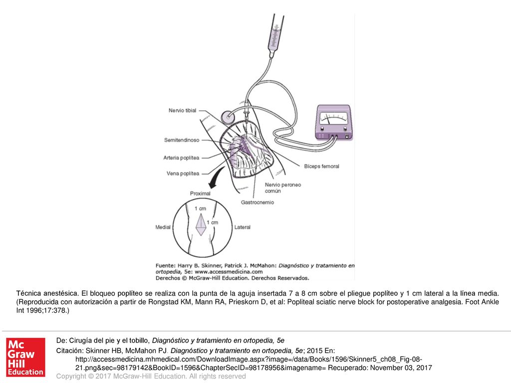 Técnica anestésica. El bloqueo poplíteo se realiza con la punta de la aguja insertada 7 a 8 cm sobre el pliegue poplíteo y 1 cm lateral a la línea media. (Reproducida con autorización a partir de Rongstad KM, Mann RA, Prieskorn D, et al: Popliteal sciatic nerve block for postoperative analgesia. Foot Ankle Int 1996;17:378.)