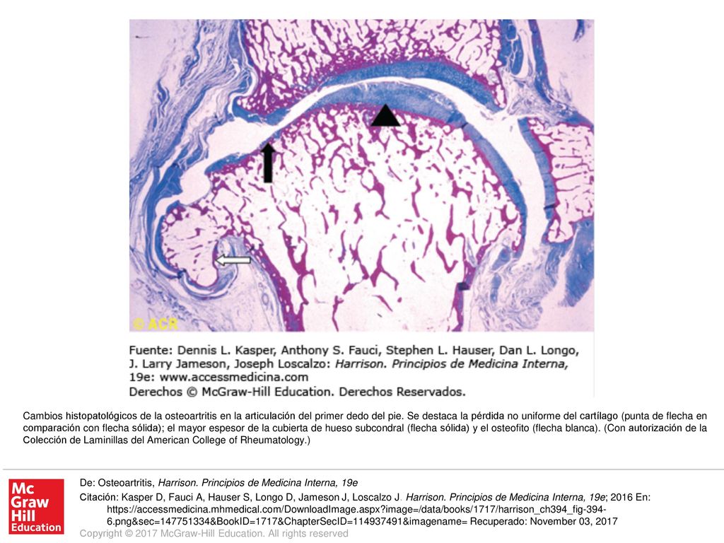 Cambios histopatológicos de la osteoartritis en la articulación del primer dedo del pie. Se destaca la pérdida no uniforme del cartílago (punta de flecha en comparación con flecha sólida); el mayor espesor de la cubierta de hueso subcondral (flecha sólida) y el osteofito (flecha blanca). (Con autorización de la Colección de Laminillas del American College of Rheumatology.)
