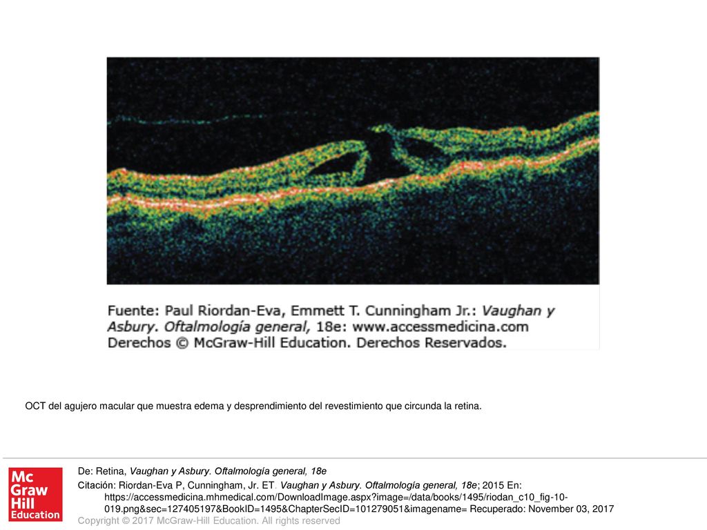 OCT del agujero macular que muestra edema y desprendimiento del revestimiento que circunda la retina.