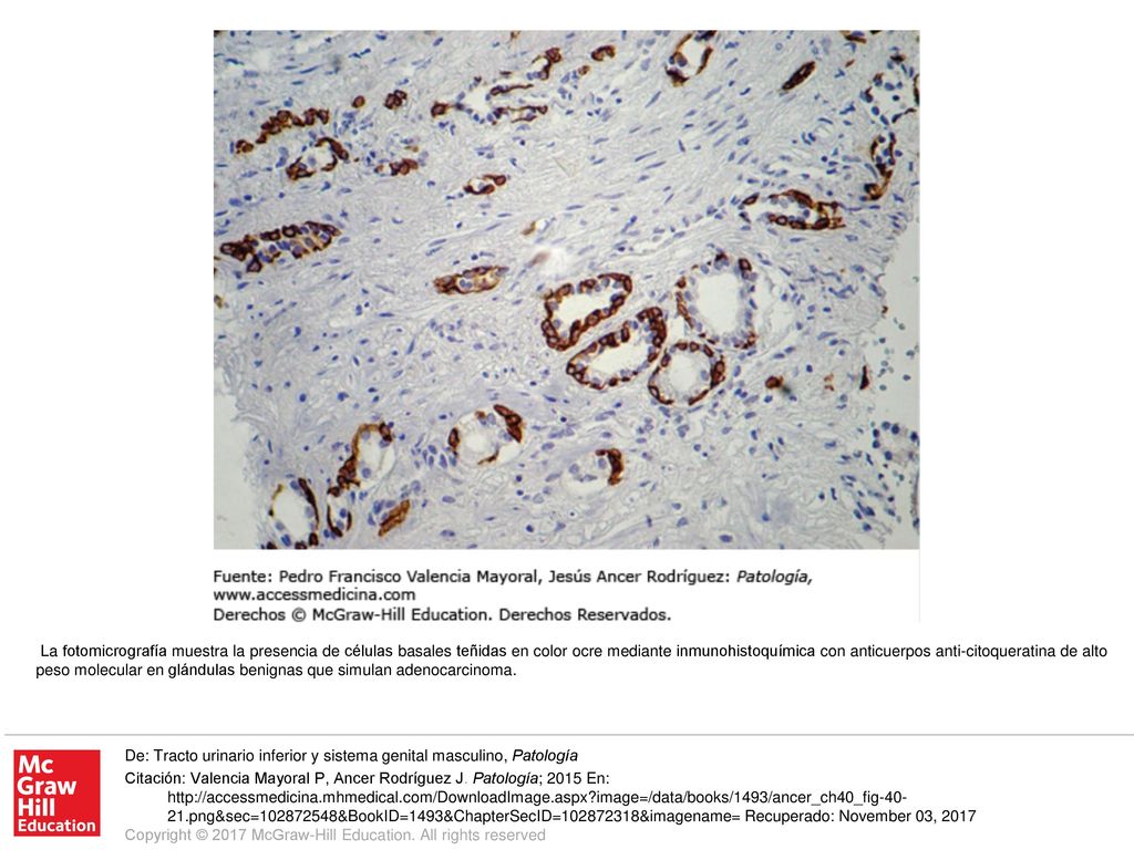 La fotomicrografía muestra la presencia de células basales teñidas en color ocre mediante inmunohistoquímica con anticuerpos anti-citoqueratina de alto peso molecular en glándulas benignas que simulan adenocarcinoma.