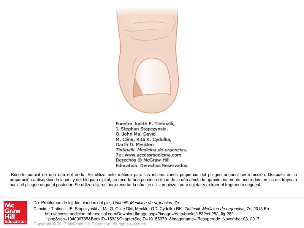 Recorte parcial de una uña del dedo