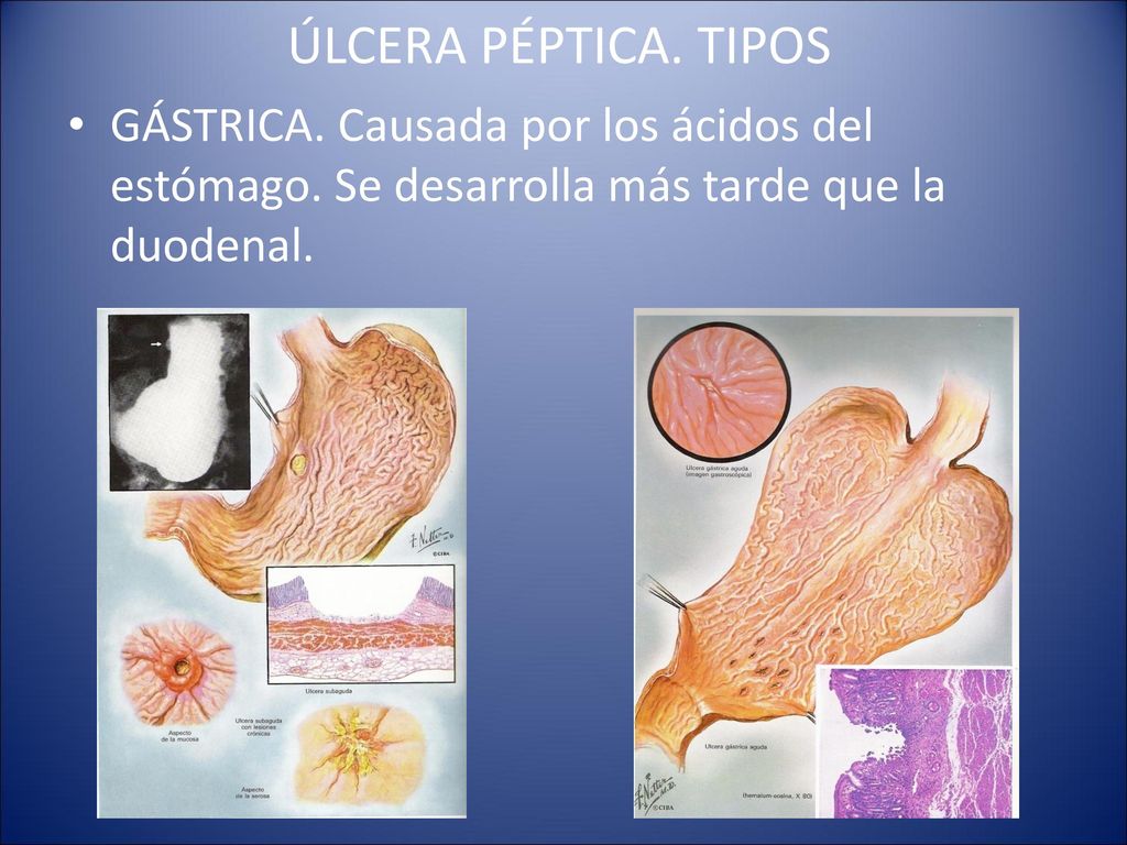 ÚLCERA PÉPTICA. TIPOS GÁSTRICA. Causada por los ácidos del estómago.