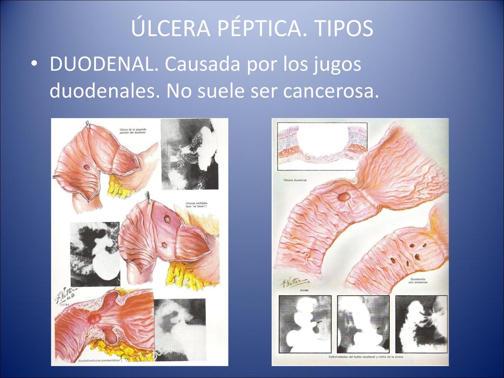 ÚLCERA PÉPTICA. TIPOS DUODENAL. Causada por los jugos duodenales. No suele ser cancerosa.