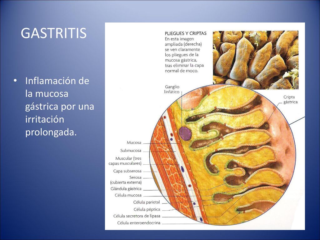 GASTRITIS Inflamación de la mucosa gástrica por una irritación prolongada.