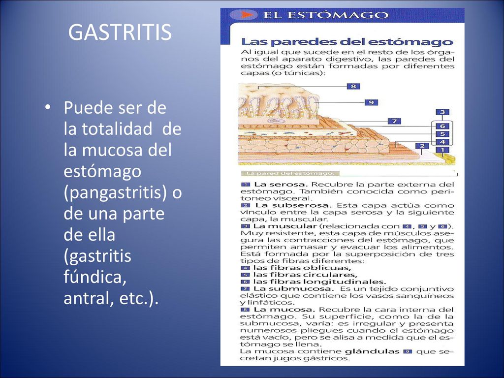 GASTRITIS Puede ser de la totalidad de la mucosa del estómago (pangastritis) o de una parte de ella (gastritis fúndica, antral, etc.).